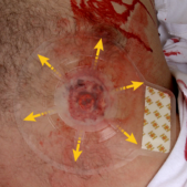 chest-seal-vented-hh